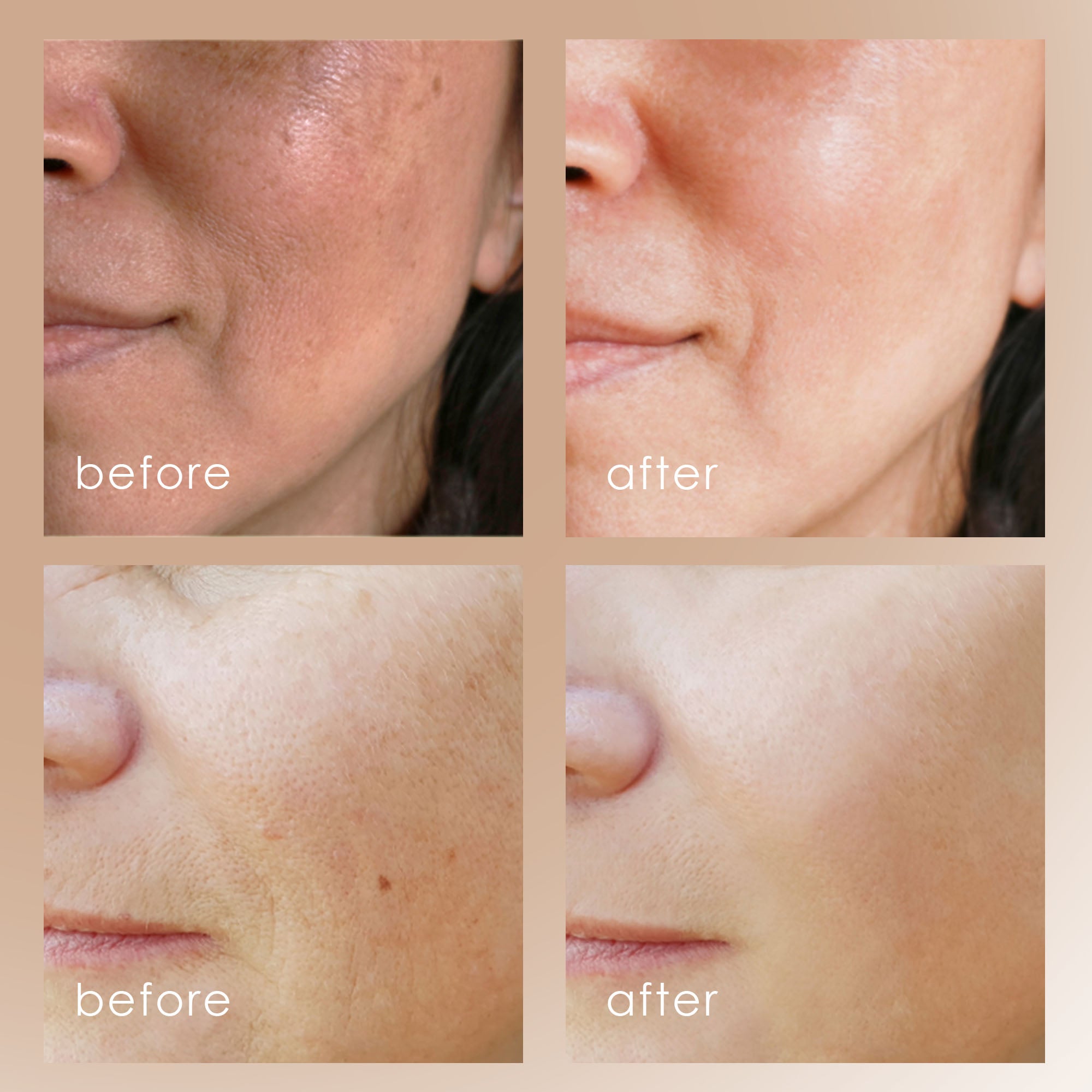 Reinvo | Facial Microdermabrasion Wand - Project E Beauty